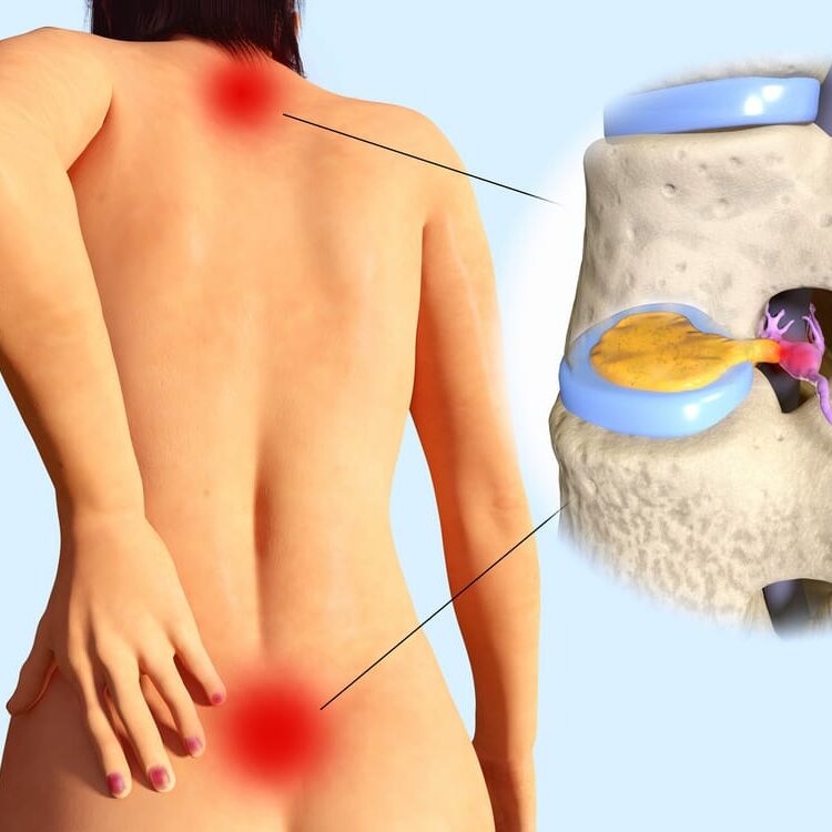 Medical illustration of a woman suffers from herniated disc.