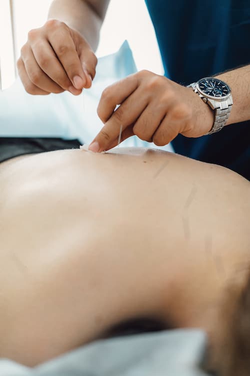 procedure on acupuncture dry needling